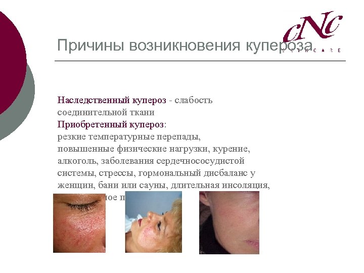 Причины возникновения купероза Наследственный купероз - слабость соединительной ткани Приобретенный купероз: резкие температурные перепады,