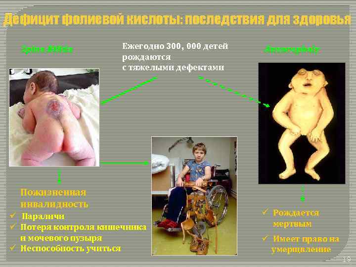 Дефицит фолиевой кислоты: последствия для здоровья Spina Bifida Ежегодно 300, 000 детей рождаются с