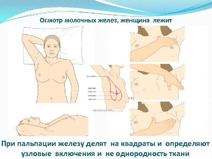 Осмотр молочных желез, женщина лежит При пальпации железу делят на квадраты и определяют узловые