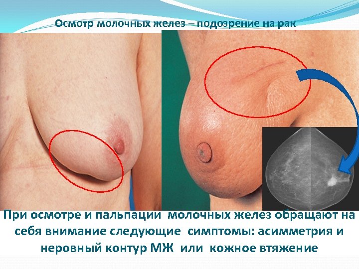 Осмотр молочных желез – подозрение на рак При осмотре и пальпации молочных желез обращают