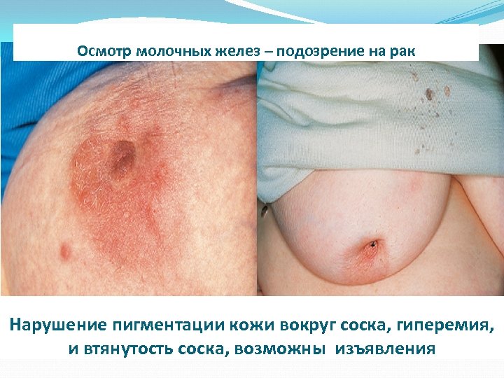 Осмотр молочных желез – подозрение на рак Нарушение пигментации кожи вокруг соска, гиперемия, и