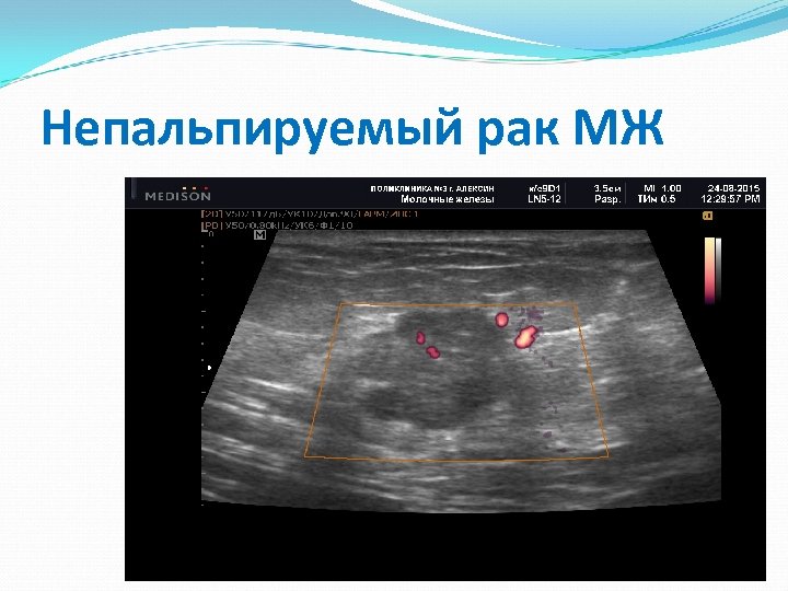 Непальпируемый рак МЖ 