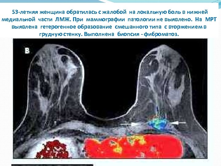 53 -летняя женщина обратилась с жалобой на локальную боль в нижней медиальной части ЛМЖ.