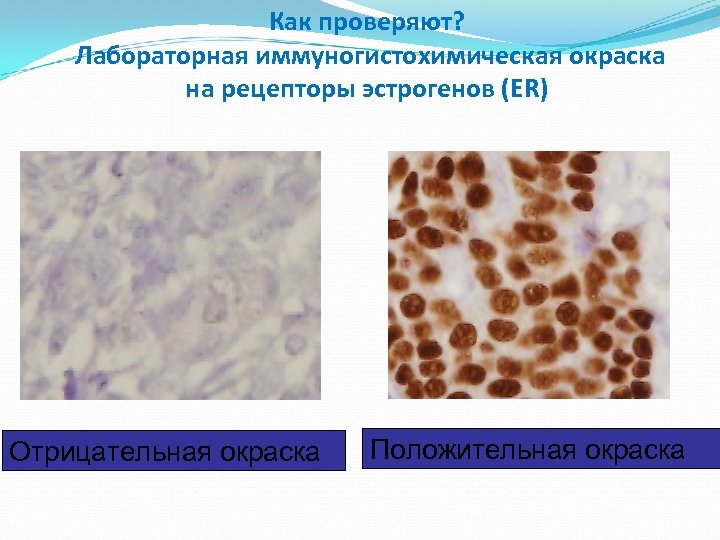 Как проверяют? Лабораторная иммуногистохимическая окраска на рецепторы эстрогенов (ER) Отрицательная окраска Положительная окраска 