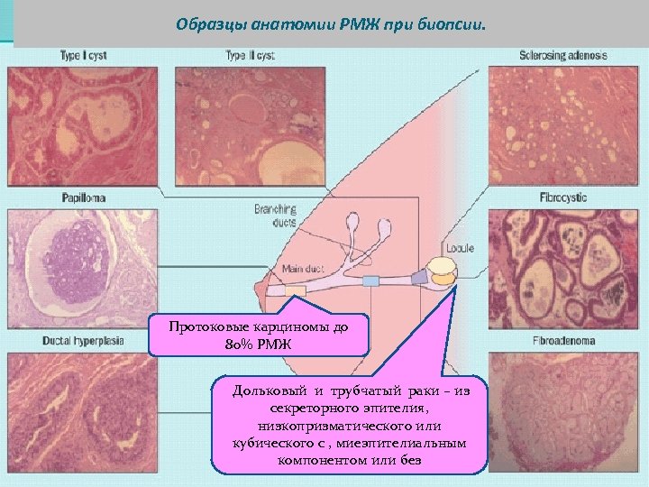 Образцы анатомии РМЖ при биопсии. Протоковые карциномы до 80% РМЖ Дольковый и трубчатый раки
