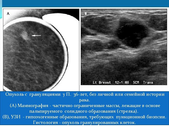  Опухоль с грануляциями у П. 36 -лет, без личной или семейной истории рака.