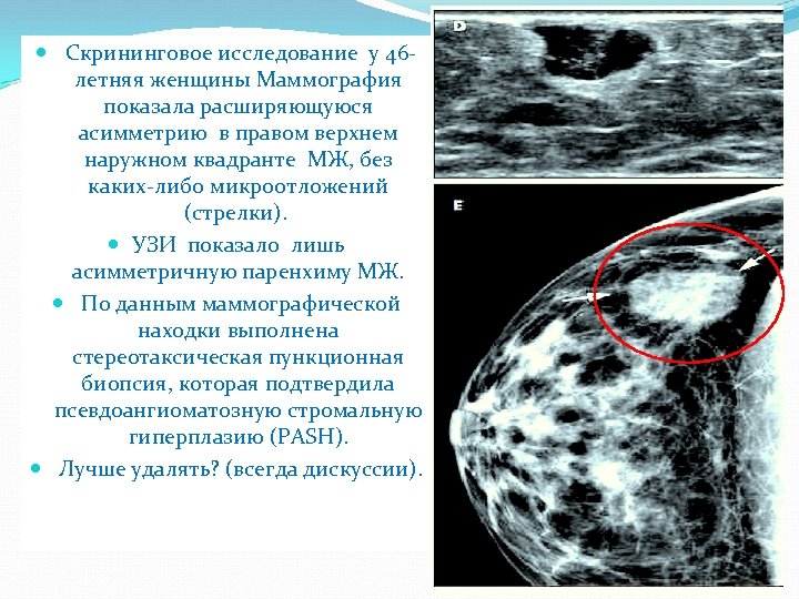  Скрининговое исследование у 46 летняя женщины Маммография показала расширяющуюся асимметрию в правом верхнем