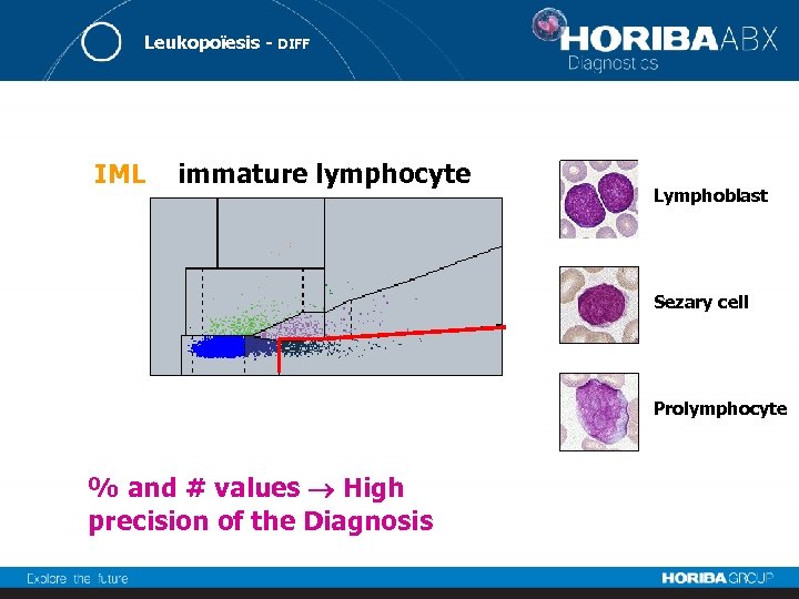 Leukopoïesis - DIFF IML immature lymphocyte Lymphoblast Sezary cell Prolymphocyte % and # values