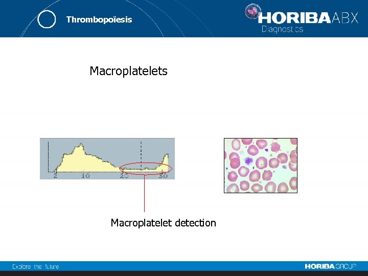 Thrombopoïesis Macroplatelet detection 