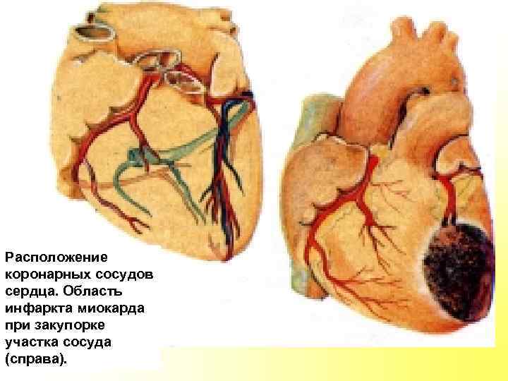 Расположение коронарных сосудов сердца. Область инфаркта миокарда при закупорке участка сосуда (справа). 