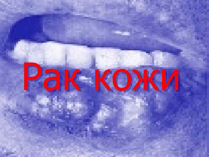  Рак кожи 