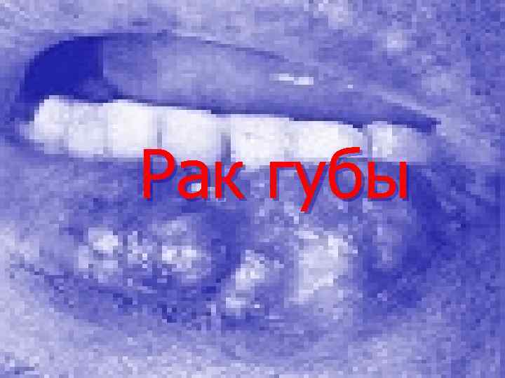 Рак губы 