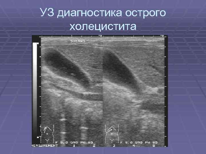 Для эхографической картины острого холецистита характерно тест ответ