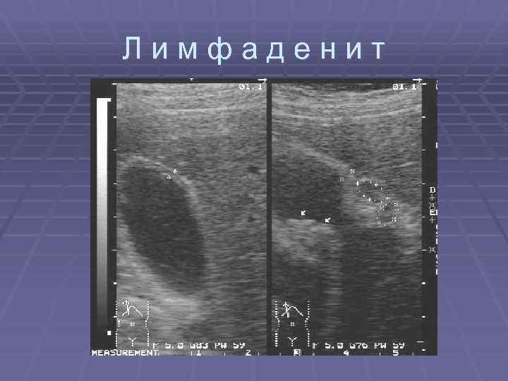 Лимфаденит 