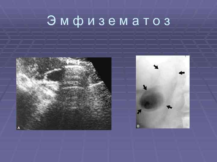 Эмфизематоз 