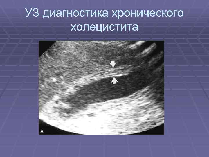 УЗ диагностика хронического холецистита 