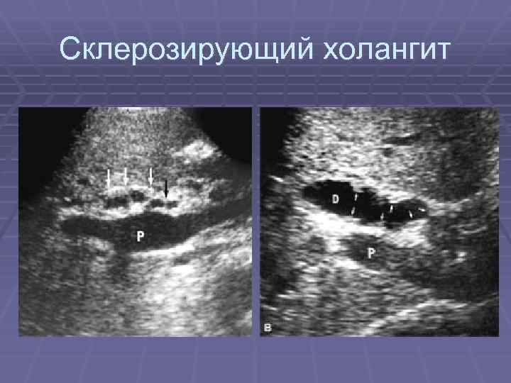 Склерозирующий холангит 