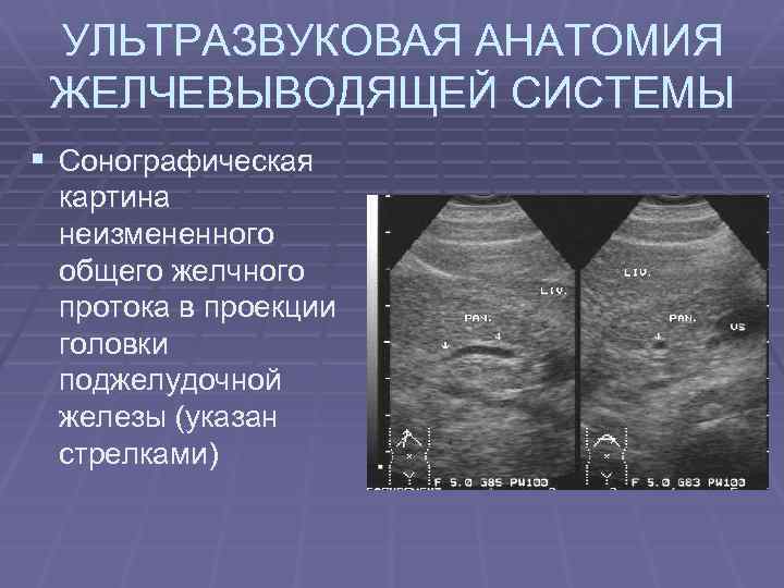 УЛЬТРАЗВУКОВАЯ АНАТОМИЯ ЖЕЛЧЕВЫВОДЯЩЕЙ СИСТЕМЫ § Сонографическая картина неизмененного общего желчного протока в проекции головки