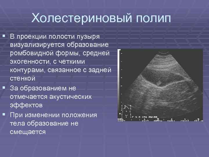 Холестериновый полип § В проекции полости пузыря § § визуализируется образование ромбовидной формы, средней