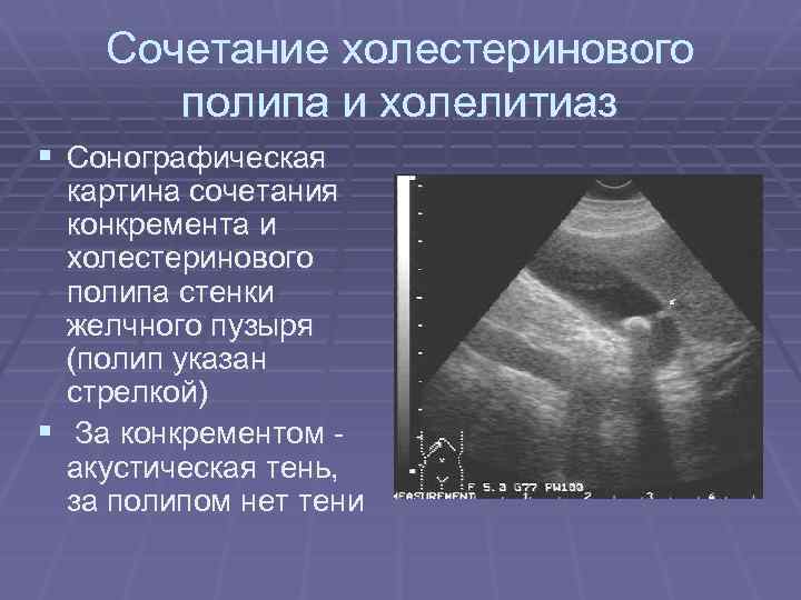Сочетание холестеринового полипа и холелитиаз § Сонографическая картина сочетания конкремента и холестеринового полипа стенки