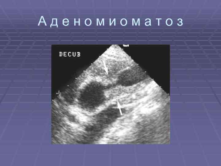 Аденомиоматоз 