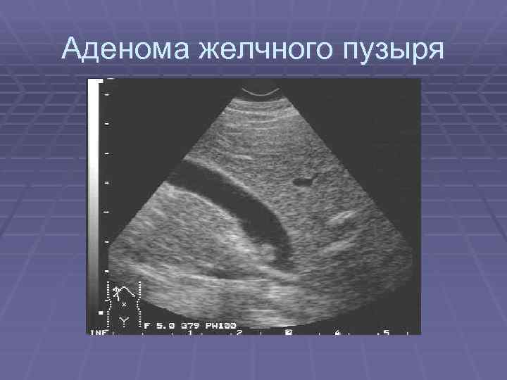 Аденома желчного пузыря 