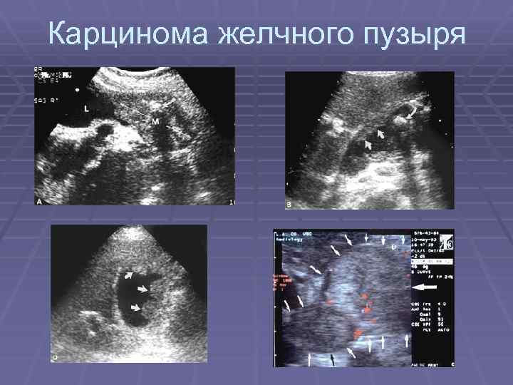 Карцинома желчного пузыря 