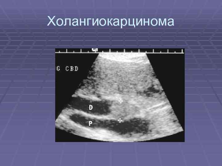 Холангиокарцинома 