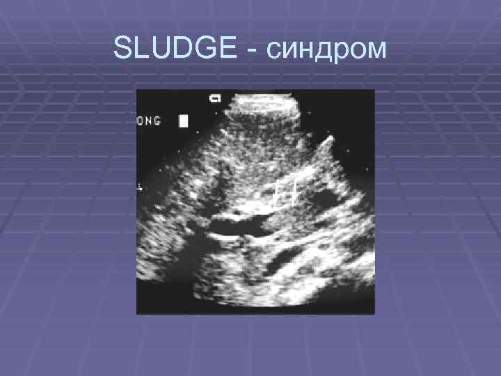 SLUDGE - синдром 