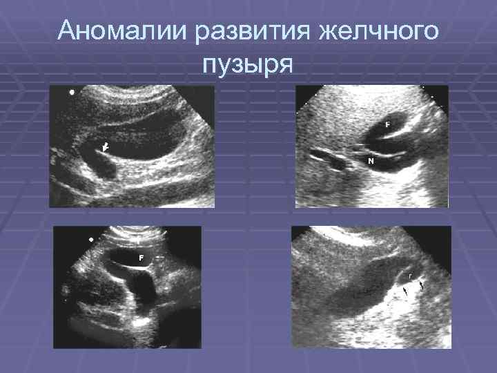 Аномалии развития желчного пузыря 