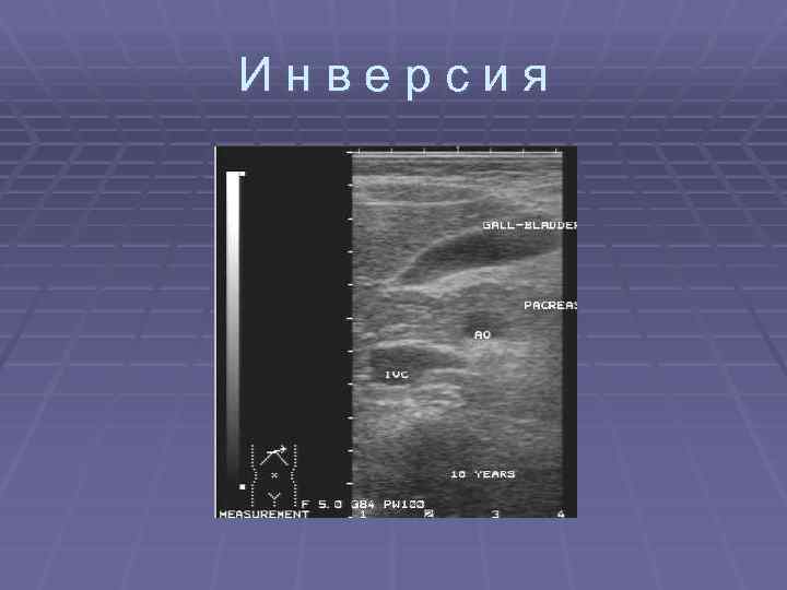 Инверсия 