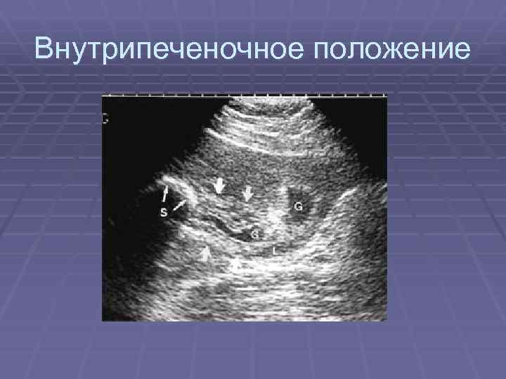 Внутрипеченочное положение 
