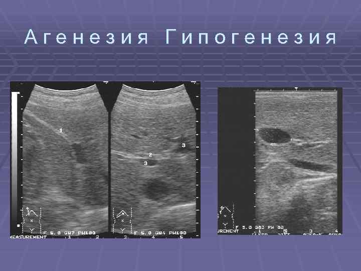 Агенезия Гипогенезия 