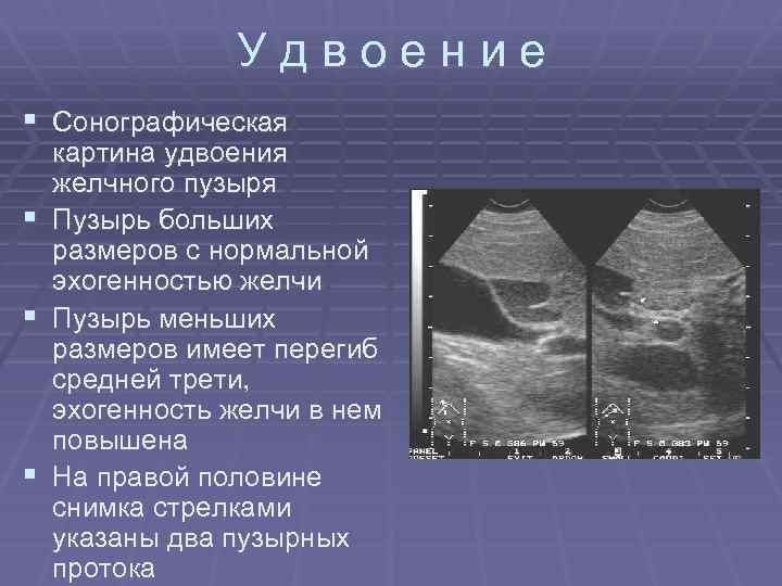 Удвоение § Сонографическая § § § картина удвоения желчного пузыря Пузырь больших размеров с