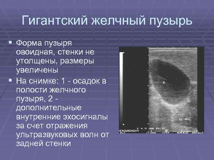 Гигантский желчный пузырь § Форма пузыря овоидная, стенки не утолщены, размеры увеличены § На