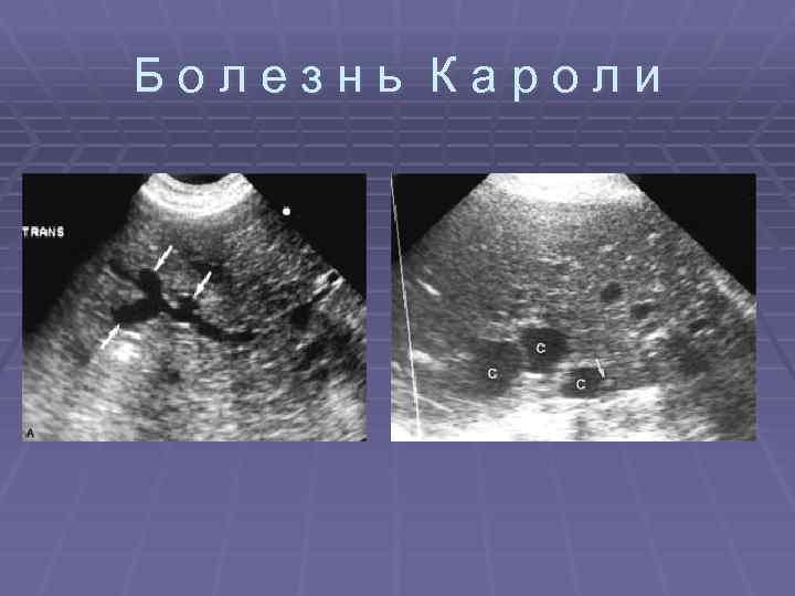 Болезнь Кароли 