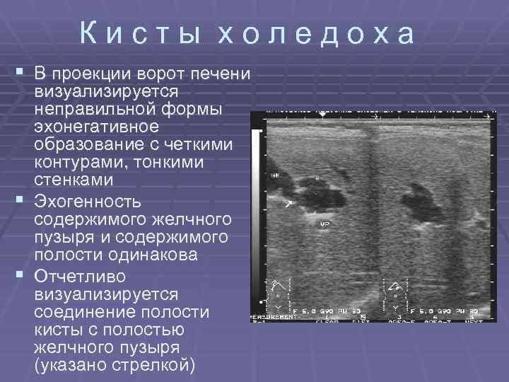 Кисты холедоха § В проекции ворот печени визуализируется неправильной формы эхонегативное образование с четкими
