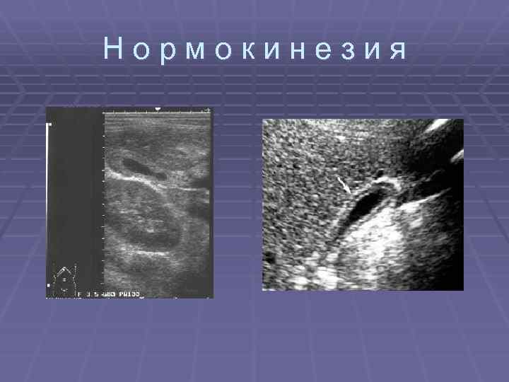 Нормокинезия 