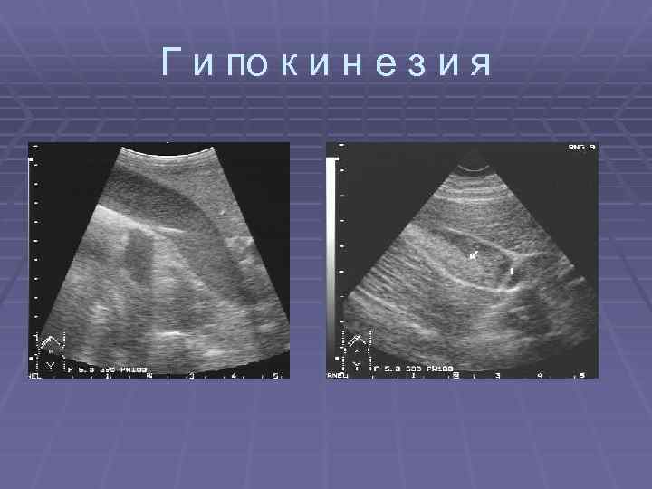 Г и по к и н е з и я 