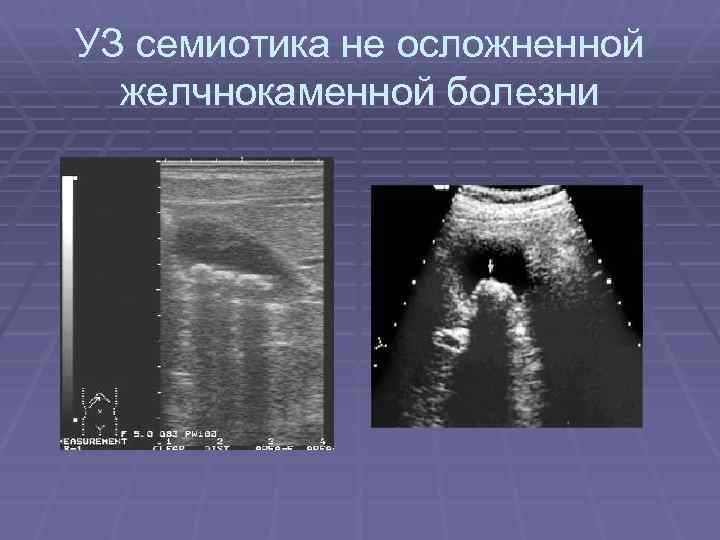 УЗ семиотика не осложненной желчнокаменной болезни 