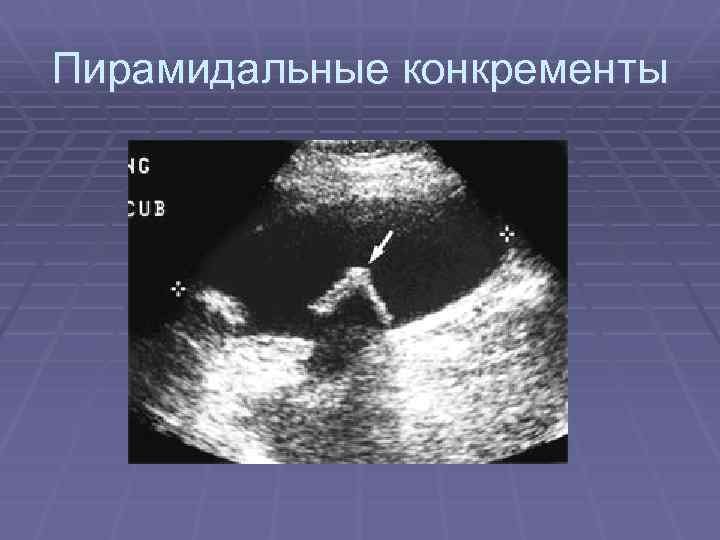 Пирамидальные конкременты 