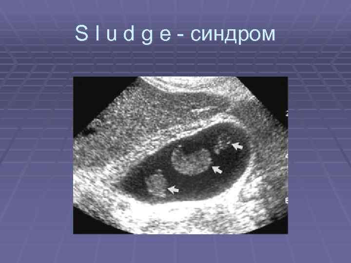 S l u d g e - синдром 