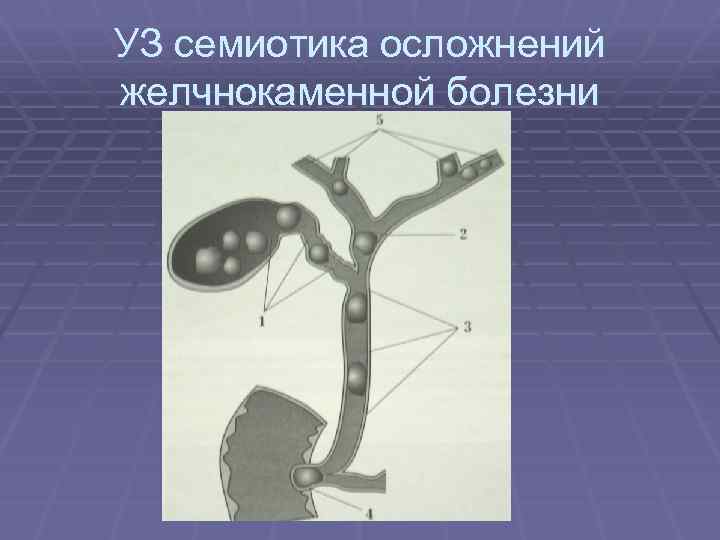 УЗ семиотика осложнений желчнокаменной болезни 