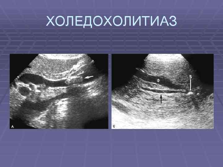 ХОЛЕДОХОЛИТИАЗ 