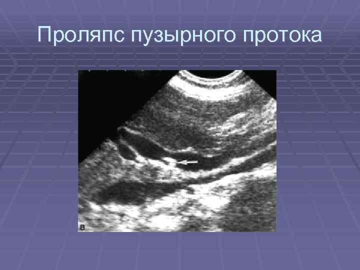 Проляпс пузырного протока 