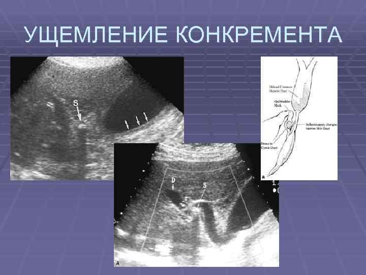 УЩЕМЛЕНИЕ КОНКРЕМЕНТА 