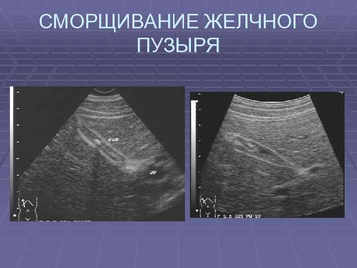 СМОРЩИВАНИЕ ЖЕЛЧНОГО ПУЗЫРЯ 