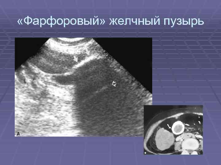  «Фарфоровый» желчный пузырь 