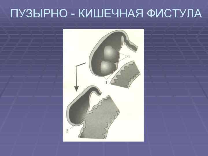 ПУЗЫРНО - КИШЕЧНАЯ ФИСТУЛА 