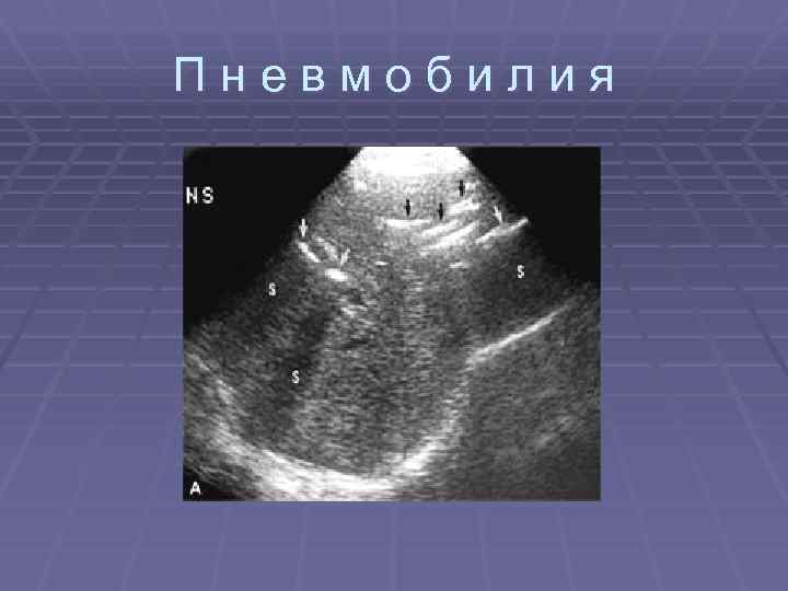 Пневмобилия 